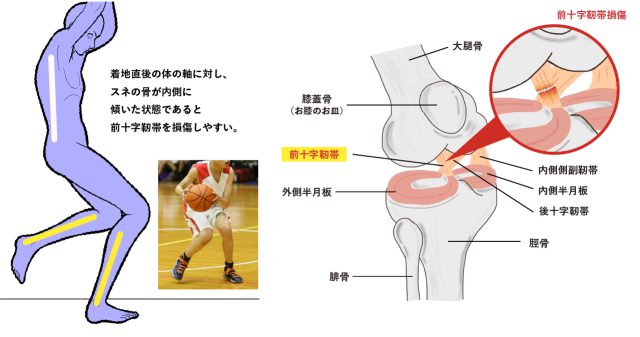 前十字靱帯 装具 右足 右膝用装具 前十字靱帯断裂 帯広厚生病院 ｜ 膝のけがについて
